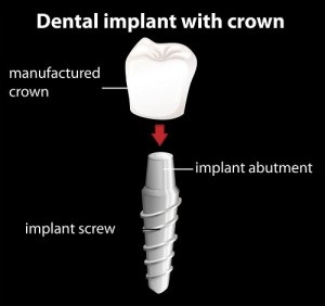 A breakdown of a dental implant.